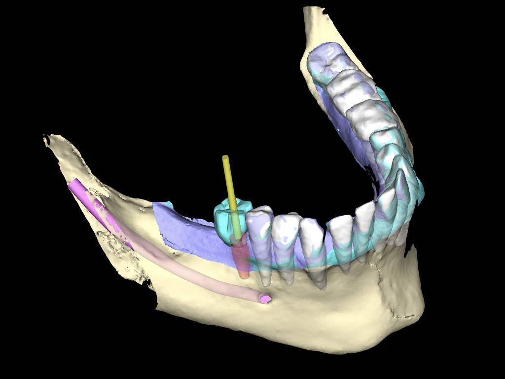 3D-Implantat­planung - HZT Hamburger Zahntechnik